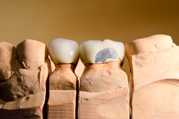 Getting A Broken  Dental Crown Repaired Or Replaced