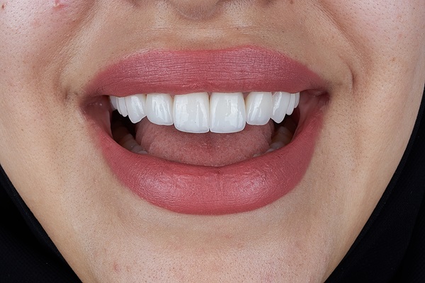 What&#    ;s Involved In The Dental Bonding Procedure?