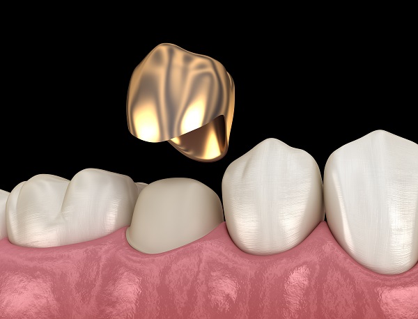 Questions To Ask Your Dentist About Dental Crown Options