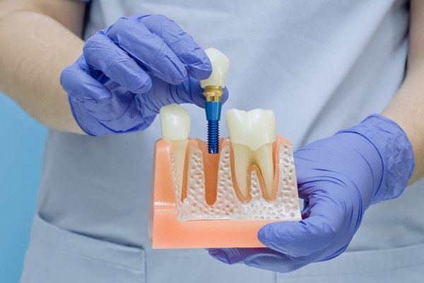 Missing A Single Tooth? Consider A Dental Implant
