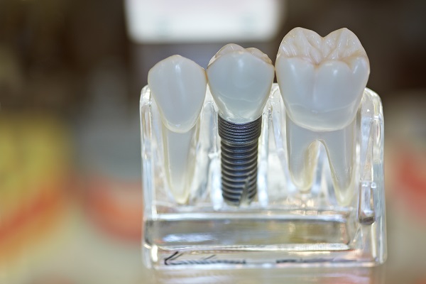 General Dentist: Reasons To Choose Dental Implants