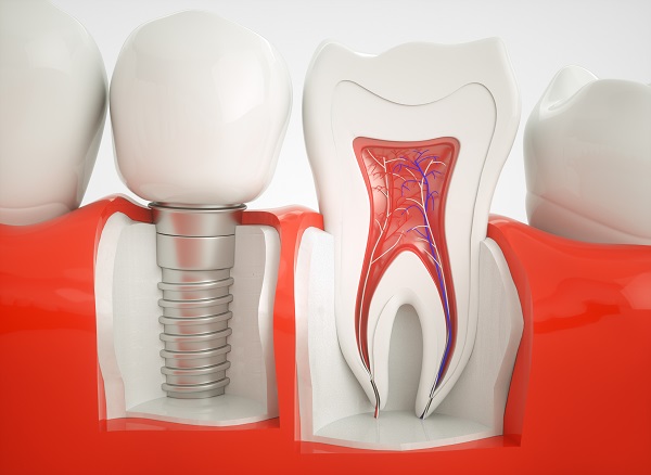 A Dental Implant Can Replace A Missing Tooth And Its Root