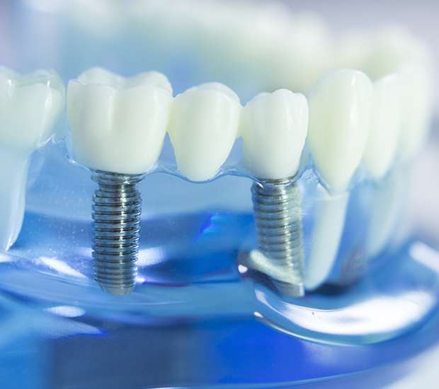 Brooklyn Dental Implants
