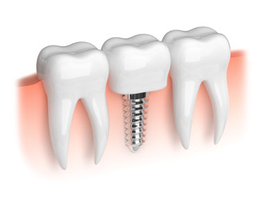 What You Should Know About Implant Dentistry