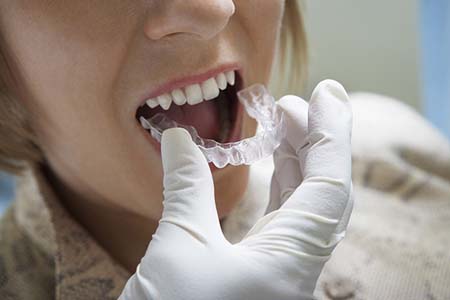 Answers To Questions About Invisalign Treatments For Adults