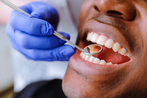Is Dental Bonding In Brooklyn, NY Permanent?
