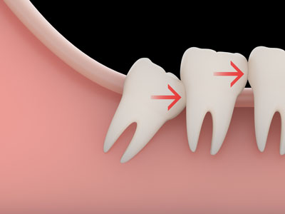 Here Is What You Should Know About Wisdom Teeth Extractions